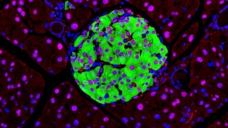 Single-gene linked to widespread type-2 diabetes via RNA disruption in insulin-producing cells
