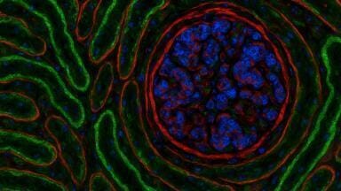 PathoPlex tech maps protein patterns to detect kidney stress in type 2 diabetes