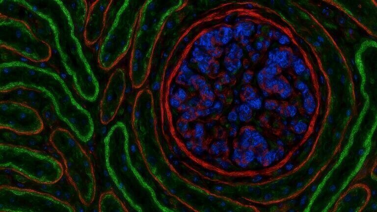 PathoPlex tech maps protein patterns to detect kidney stress in type 2 diabetes