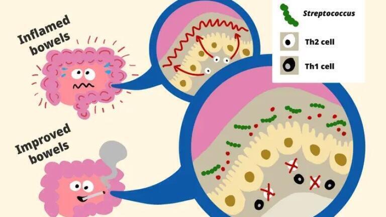 In ulcerative colitis, excessive Th2 immune activity drives intestinal inflammation. Smoking generates aromatic compounds such as hydroquinone in the colonic mucosa, enabling oral bacteria like Streptococcus to colonise. These trigger Th1 cell activation, which suppresses Th2 activity and reduces inflammation. Credit: RIKEN
