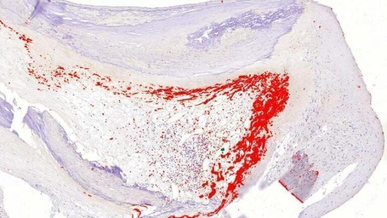 Asymptomatic bacterial biofilm lining a cholesterol-laden coronary artery plaque. Credit: Pekka Karhunen’s research group, Tampere University