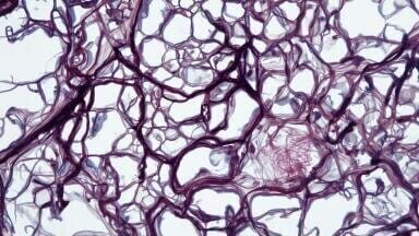 Millions with hepatitis B may avoid routine liver cancer checks