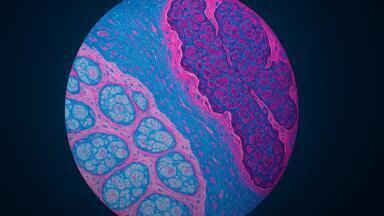 Spectroscopy study identifies potential biomarkers for rare metaplastic breast carcinoma tissue