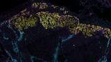 Breast cancer remodels lymphatic vessels to spread