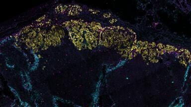 Breast cancer remodels lymphatic vessels to spread