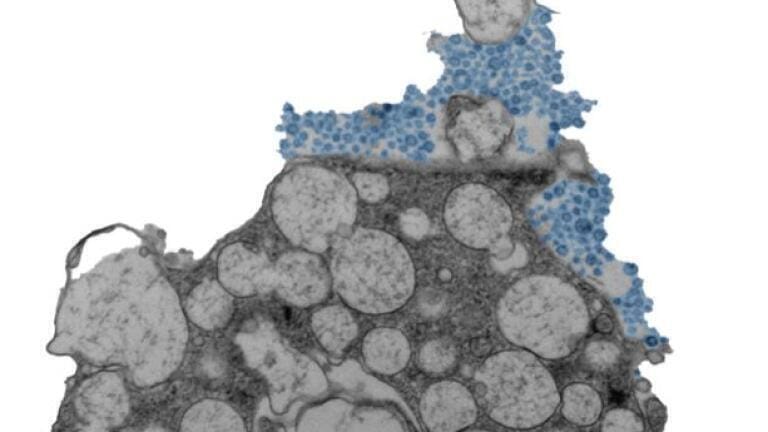 Electron micrograph showing a human nasal epithelial cell releasing rhinovirus (blue). Credit: Julien Amat & Bao Wang