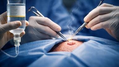 Pre-surgery pembrolizumab has success clearing tumours in most patients with desmoplastic melanoma, trial reports