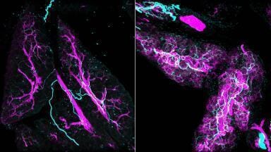 Early nerve–fibroblast crosstalk drives pancreatic cancer development: study 