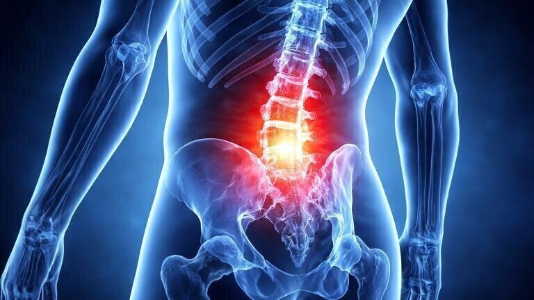 Parathyroid hormone may curb abnormal nerve growth and ease chronic pain in spinal degeneration