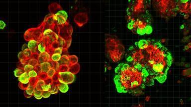 Ovarian cancer study reveals normal cells in abdomen hijacked to drive rapid spread of disease
