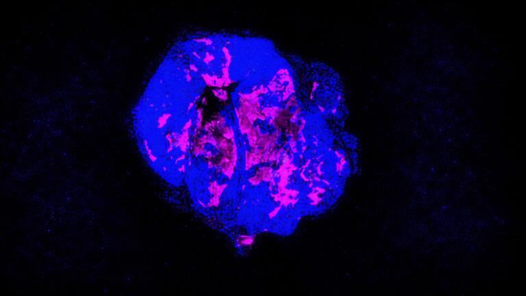 Cytomegalovirus Immunity Shows Promise in Pancreatic Cancer Therapy | UC San Diego Research