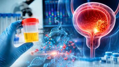 Urine DNA test predicts bladder cancer recurrence and guides BCG therapy