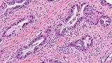 Consensus defines oligometastatic pancreatic cancer