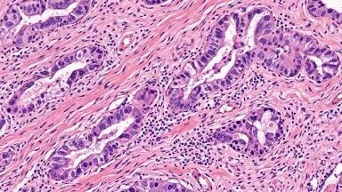 Consensus defines oligometastatic pancreatic cancer