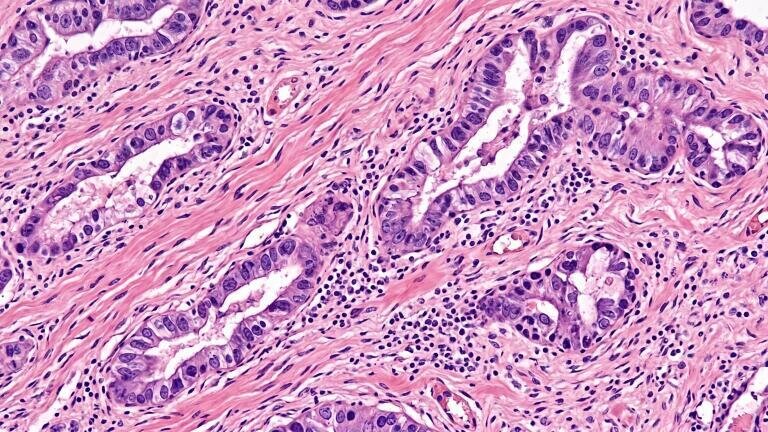 Consensus defines oligometastatic pancreatic cancer