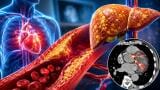 Fatty liver disease linked to higher burden of coronary plaques prone to rupture risk