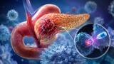 KRAS G12D targeted therapy shows early promise in metastatic pancreatic cancer