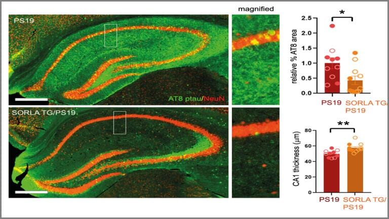 An overabundance of SORLA protein protects against a number of biological processes linked to the formation of tau tangles and progression of neurodegeneration. These include reducing the addition of too many phosphate groups to tau, known as hyperphosphorylation. In these biopsy images, less phosphorylated tau—stained to appear green—has accumulated in the bottom sample overexpressing SORLA. Credit: Tim Huang, Huijie Huang, Sanford Burnham Prebys