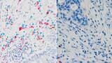Immune molecule found to help cancer immunotherapy work from within tumours