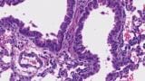 Arginine deficiency found to weaken the immunity against cancer and viruses