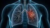 Fungal and bacterial triggers may be drivers in steroid-resistant asthma