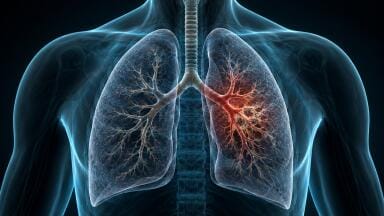 Fungal and bacterial triggers may be drivers in steroid-resistant asthma