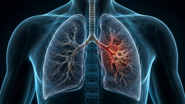 Fungal and bacterial triggers may be drivers in steroid-resistant asthma
