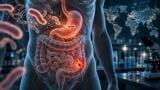 Helicobacter pylori may be linked to more than 20 per cent of bowel cancer cases