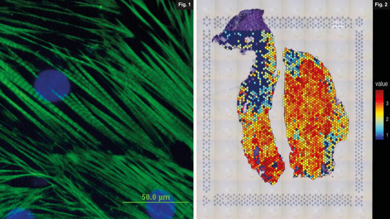 [From left] Fig1. The scientists transplanted CVPs (above) into pig hearts and tracked the genes expressed by the cells as they matured into heart muscle cells. Credit: LKCMedicine.  Fig2. To detect gene activity after stem cell transplantation, a section of pig heart is placed on a slide containing probes that bind to RNA molecules produced by genes in the stem cells. In this molecular heat map, each coloured dot represents a small patch of tissue approximately 55 micrometres across. The colour indicates how actively the gene is being expressed – red dots signal high activity; blue dots signal low activity. Credit: LKCMedicine