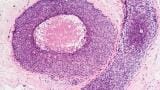 High RNA quality FFPE tissue blocks for biomarker discovery