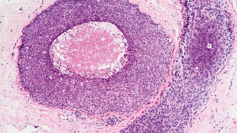 High RNA quality FFPE tissue blocks for biomarker discovery